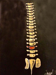 Aldo Isassi, «Dolor de espalda», acrílico sobre tela.